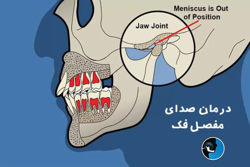 صدای مفصل فک