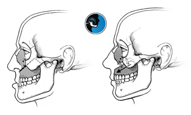 نتیجه جراحی فک