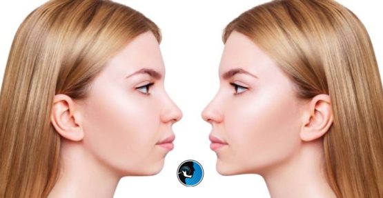 تغییری چهره بعد از جراحی فک