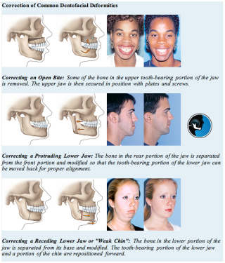 بهترین سن انجام جراحی فک