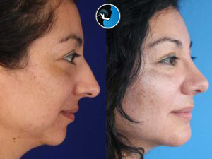 ترومای فک مادرزادی