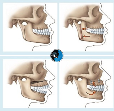 مقایسه ارتودنسی و جراحی فک