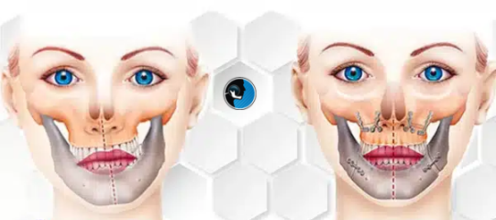 پیشگیری از عود یا شکست بعد از جراحی فک