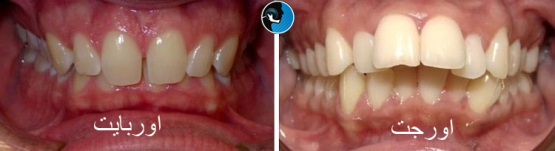 درمان بهم ریختگی فک