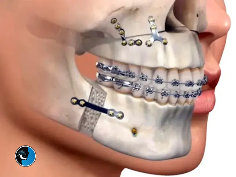 گذاشتن تراز قبل و بعد از جراحی فک