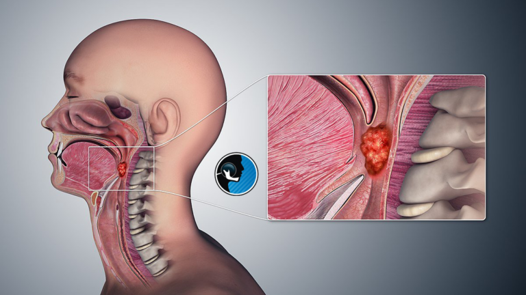 علت سرطان سر و گردن