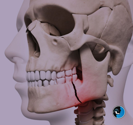 علائم شکستگی فک