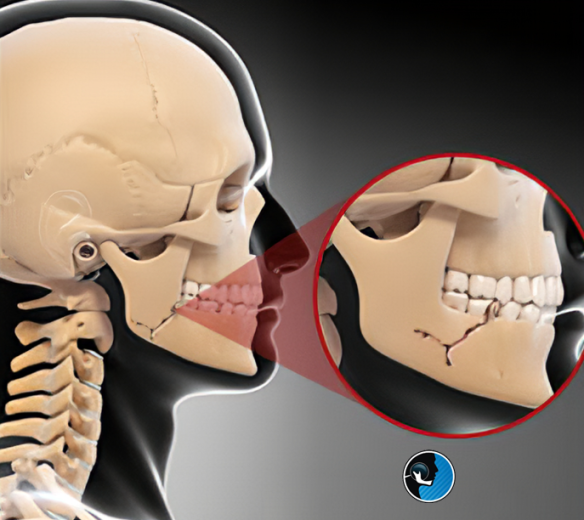 شکستگی فک بعد از تصادف