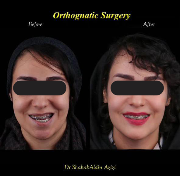 درمان انحراف فک