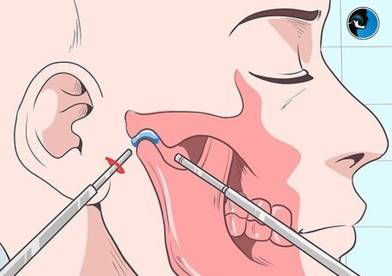 درمان بی حسی بعد از جراحی فک