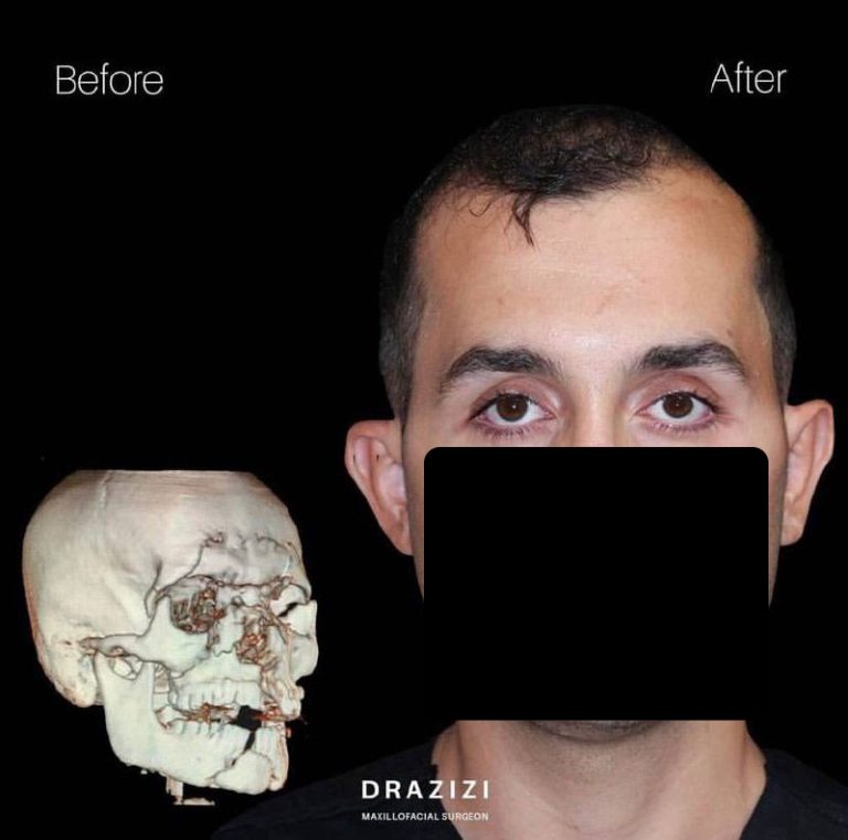 شکستگی استخوان زیر چشم