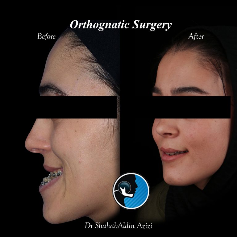 فاصله نادرست بین فک بالا و پایین