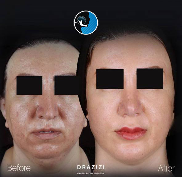 جنیوپلاستی