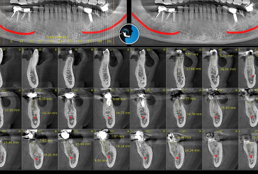 cbct استخوان فک