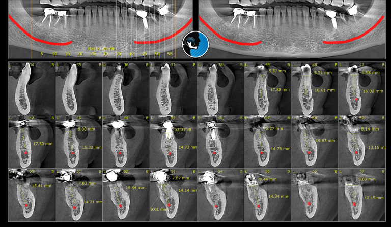 cbct استخوان فک
