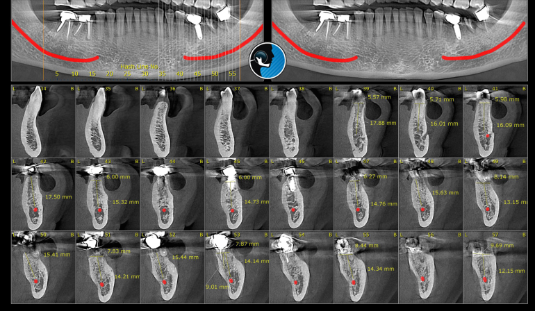 cbct استخوان فک