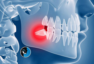 دندان های نهفته در فک