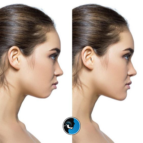 تاثیر جنیوپلاستی بر غبغب