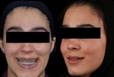 پروتز گونه همزمان با جراحی فک