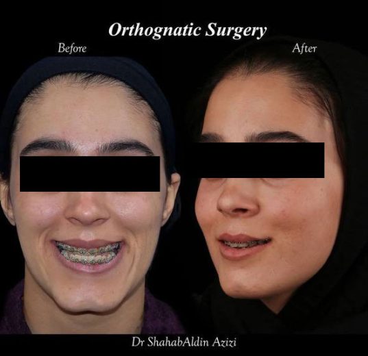 پروتز گونه همزمان با جراحی فک