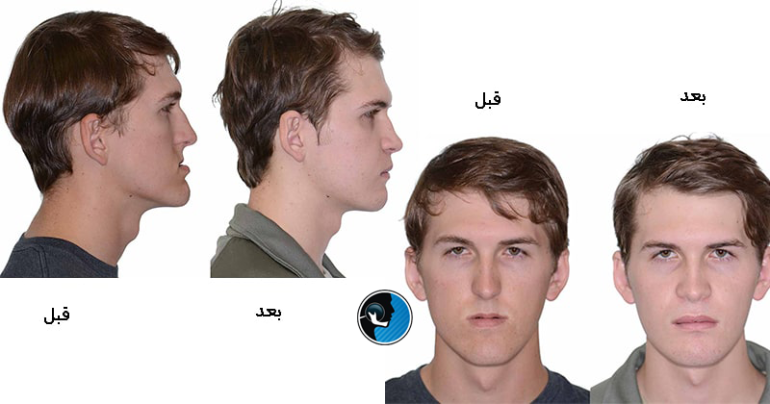 احساس ناقرینگی بعد از جراحی فک