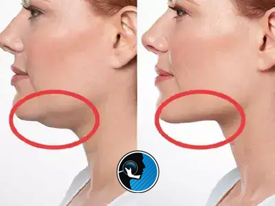 تاثیر جراحی فک بر غبغب
