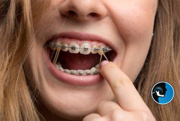 کش بعد از جراحی فک