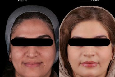 تغییرات چهره بعد از جراحی فک