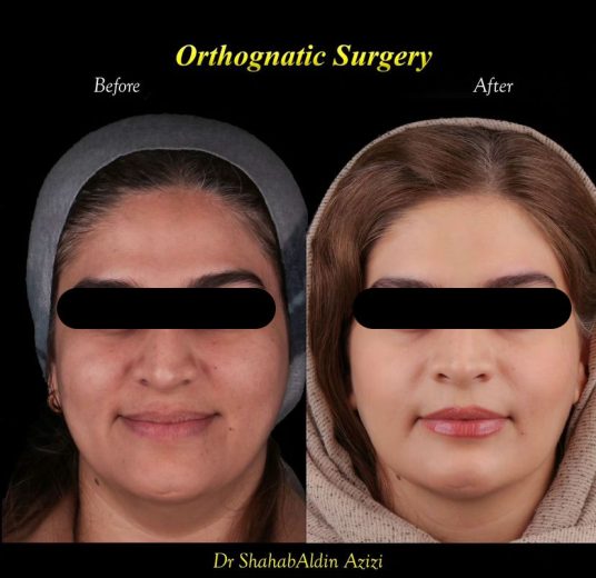 تغییرات چهره بعد از جراحی فک