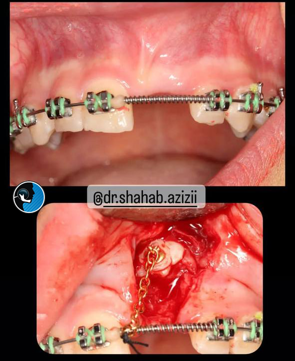 اکسپوژر دندان نهفته