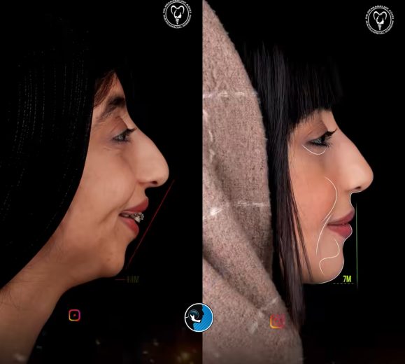 تاثیر جراحی فک برتناسب صورت