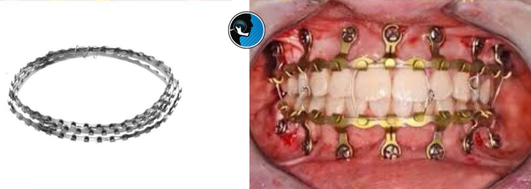 بستن فک با سیم بعد از جراحی فک