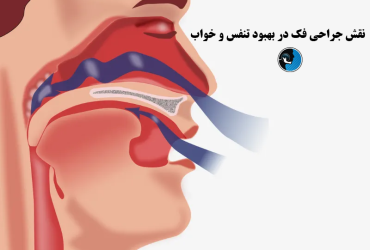 بهبود وضعیت خواب بعد از جراحی فک