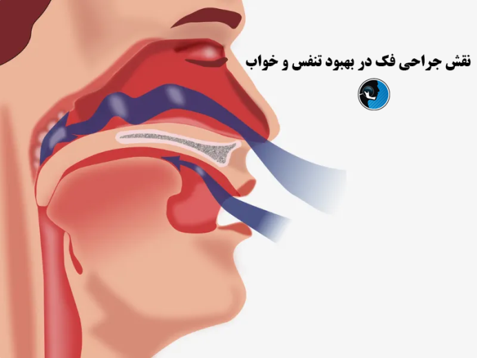 بهبود وضعیت خواب بعد از جراحی فک