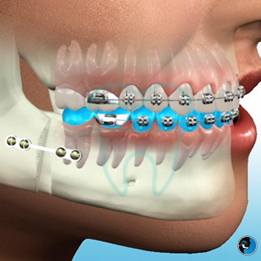 جراحی فک یا ارتودنسی؟