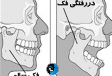 دررفتگی فک