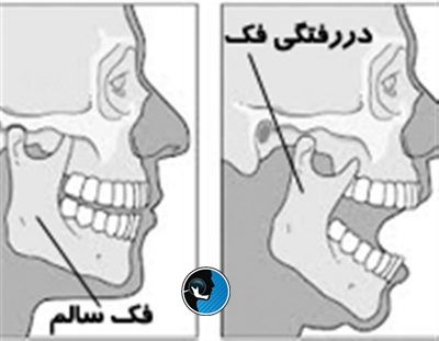 دررفتگی فک