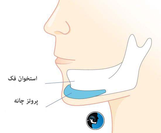 ماندگاری پروتز فک