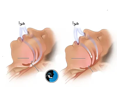 نقش جراحی فک در بهبود تنفس و خواب