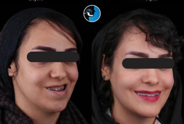 تغییرات چهره بعد از جراحی فک