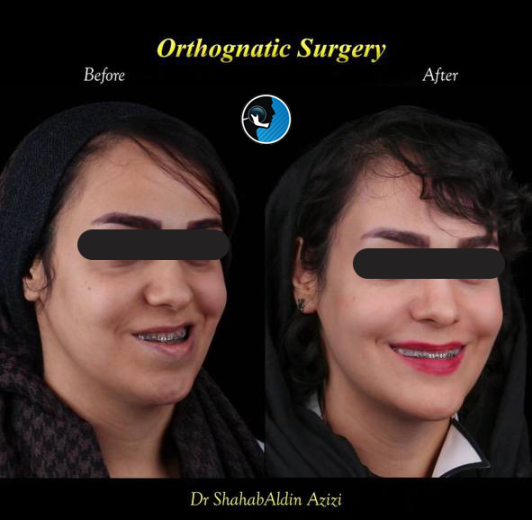 تغییرات چهره بعد از جراحی فک