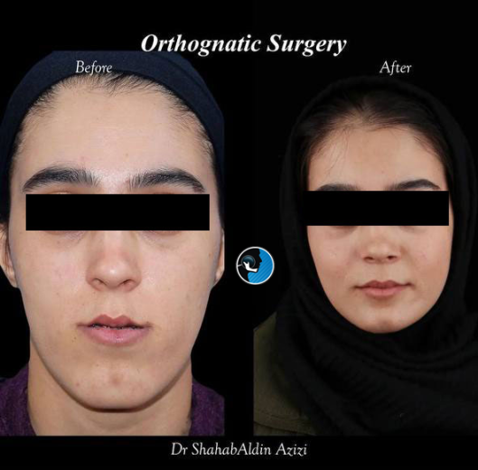 پروتز گونه به روش دیجیتال