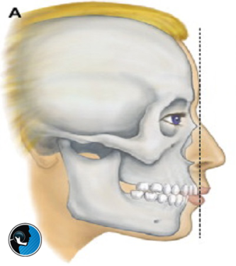 کوچکی فک پایین