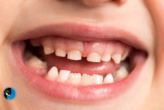 تغییر شکل دندان کودک و مشکلات فکی