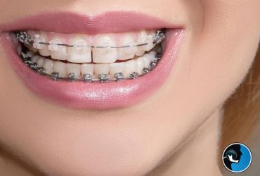 جراحی فک ترکیبی با درمان ارتودنسی