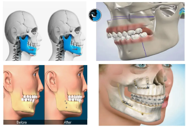 انتخاب زمان مناسب برای جراحی فک