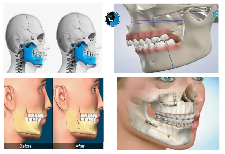 انتخاب زمان مناسب برای جراحی فک