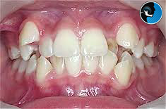 بهم ریختگی فک