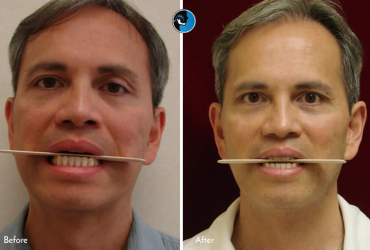 جراحی فک در بیماران مسن تر