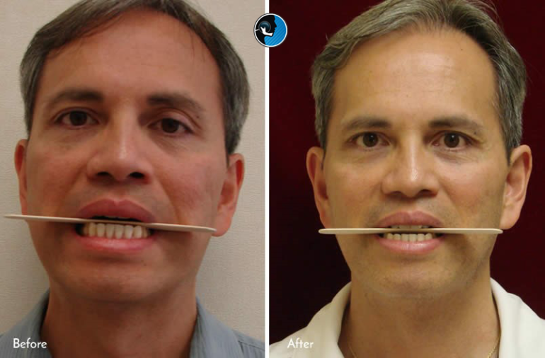 جراحی فک در بیماران مسن تر